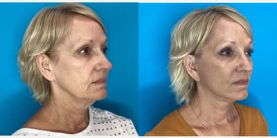 Facelift procedure image