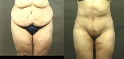 Body Lift procedure image