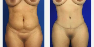 Mommy Makeover procedure image