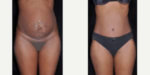 Tummy Tuck (Abdominoplasty) procedure image