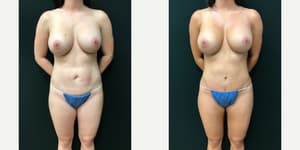 Tummy Tuck (Abdominoplasty) procedure image