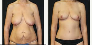 Breast Augmentation procedure image
