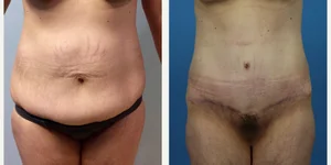 Tummy Tuck (Abdominoplasty) procedure image