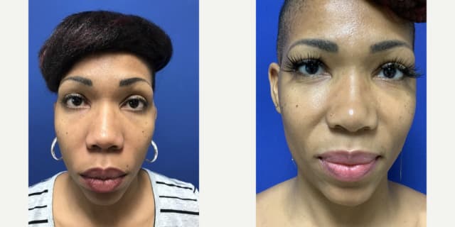 Rhinoplasty (Nose Job) procedure image