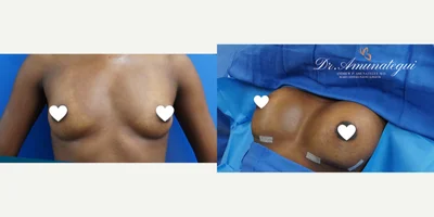 Breast Augmentation procedure image