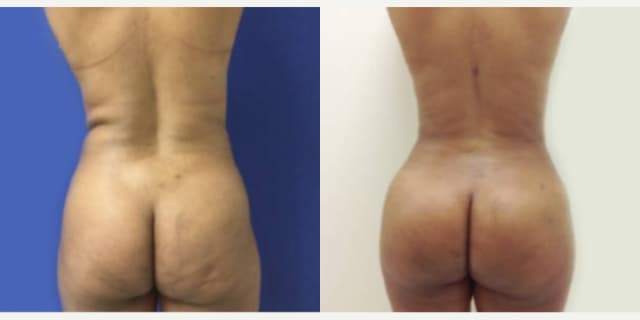 Hip Enhancement procedure image