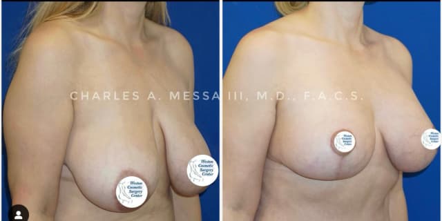 Breast Augmentation procedure image