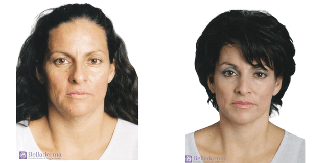 Eyelid Surgery (Blepharoplasty) procedure image