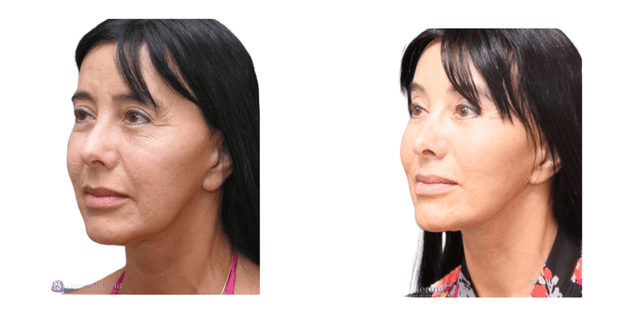 Facelift procedure image