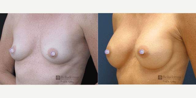 Breast Augmentation procedure image