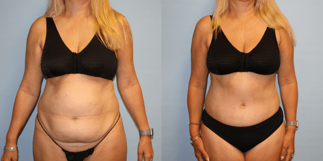 Skin Tightening procedure image