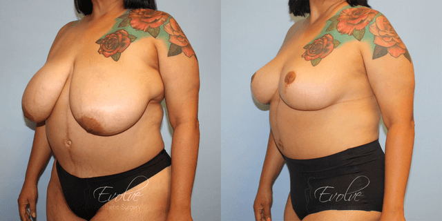 Breast Augmentation procedure image