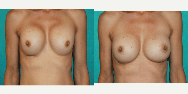 Mommy Makeover procedure image