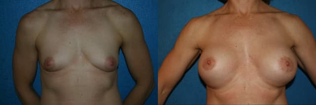 Breast Augmentation procedure image