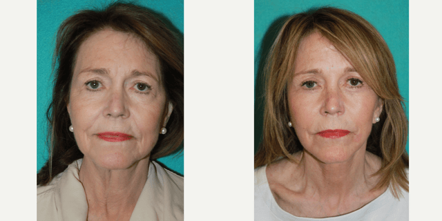 Facelift procedure image
