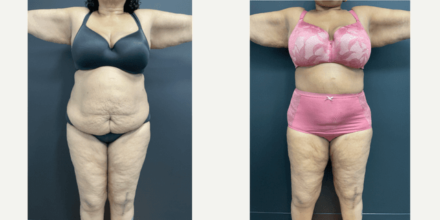 Tummy Tuck (Abdominoplasty) procedure image