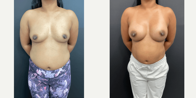 Mommy Makeover procedure image