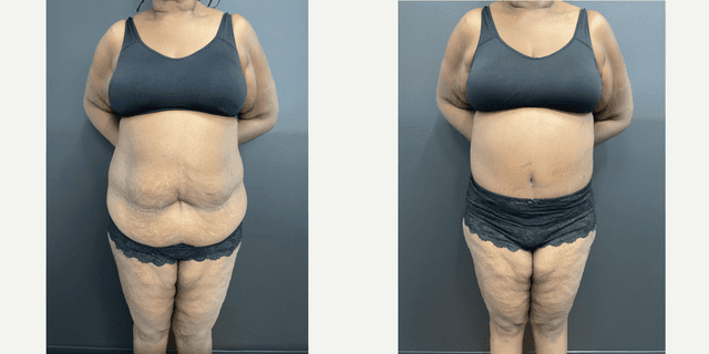 Breast Augmentation procedure image