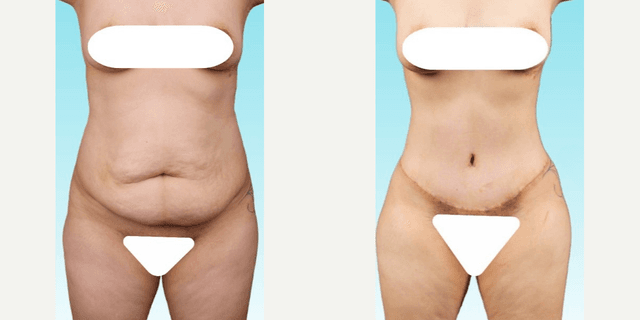Tummy Tuck (Abdominoplasty) procedure image