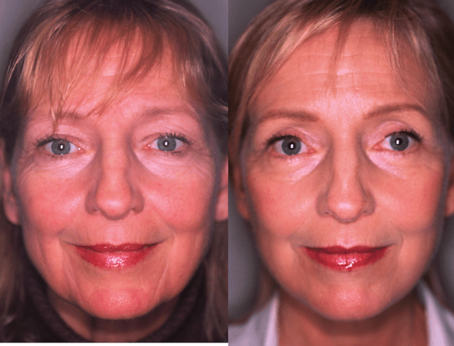 Facelift procedure image