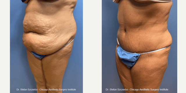 Tummy Tuck (Abdominoplasty) procedure image