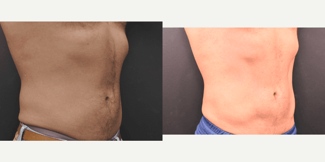 Body Lift procedure image