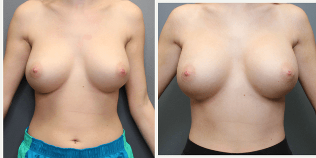 Breast Augmentation procedure image