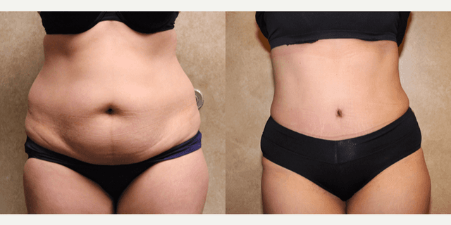 Tummy Tuck (Abdominoplasty) procedure image