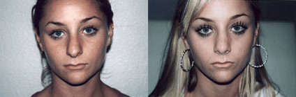 Rhinoplasty (Nose Job) procedure image