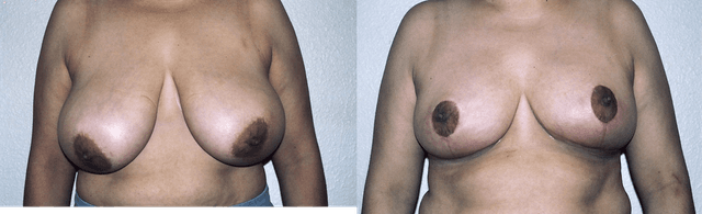 Breast Augmentation procedure image