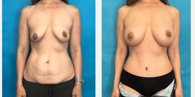 Mommy Makeover procedure image