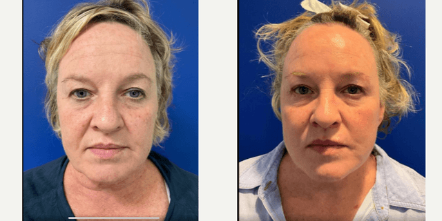 Facelift procedure image