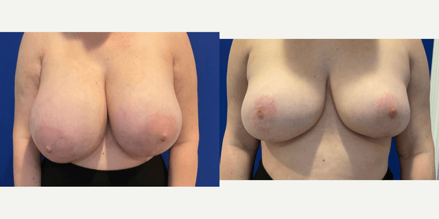 Mommy Makeover procedure image