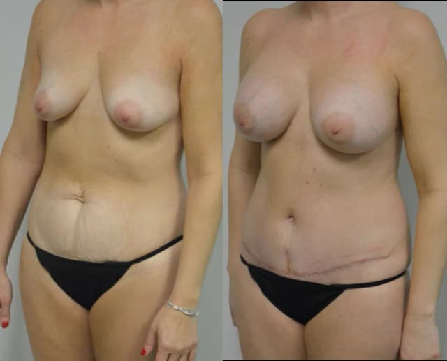 Breast Augmentation procedure image