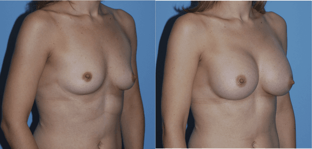 Mommy Makeover procedure image