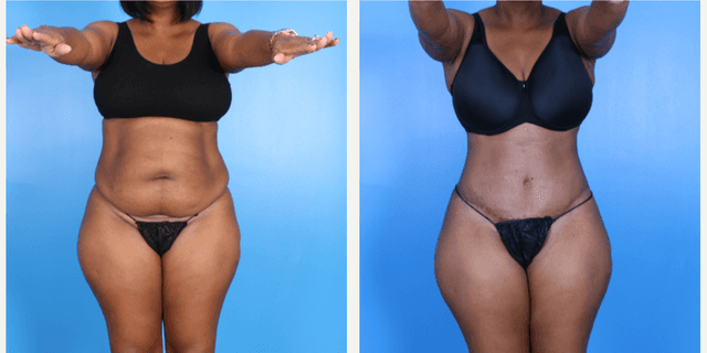 Skin Tightening procedure image