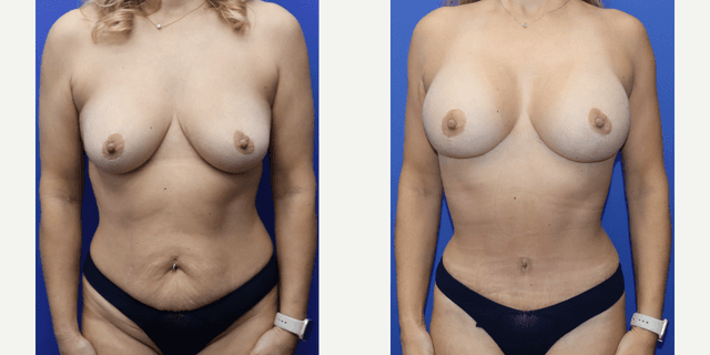 Lipo 360 procedure image