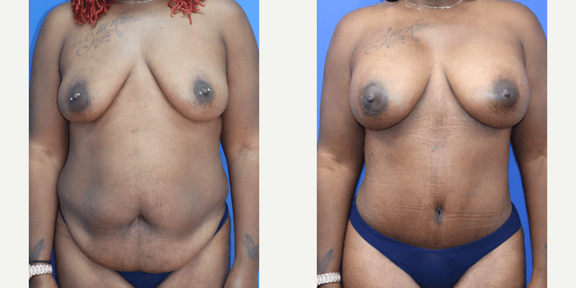 Tummy Tuck (Abdominoplasty) procedure image