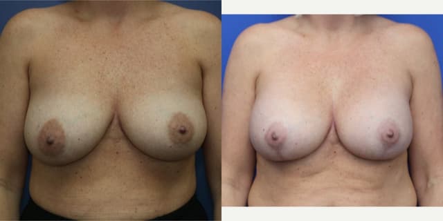Breast Augmentation procedure image