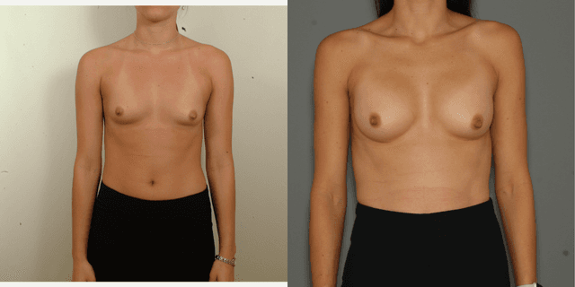 Mommy Makeover procedure image