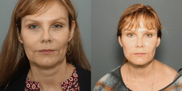 Rhinoplasty (Nose Job) procedure image