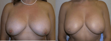 Breast Augmentation procedure image