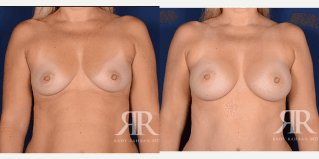 Mommy Makeover procedure image