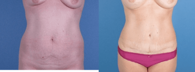 Tummy Tuck (Abdominoplasty) procedure image