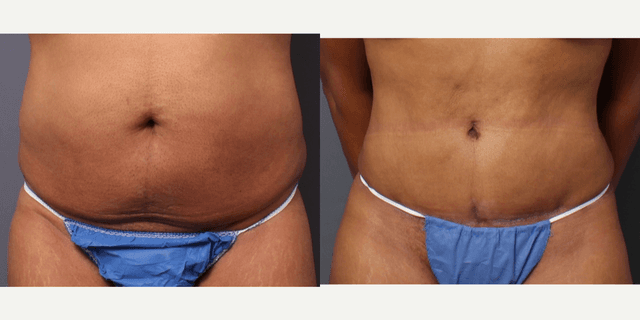 Tummy Tuck (Abdominoplasty) procedure image