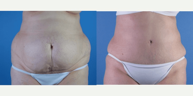 Tummy Tuck (Abdominoplasty) procedure image