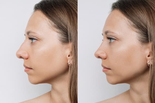 Rhinoplasty (Nose Job) procedure image