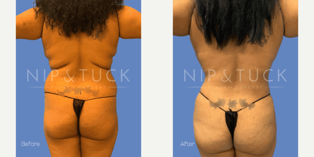 Lipo 360 procedure image