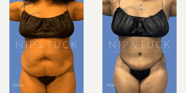 Mommy Makeover procedure image