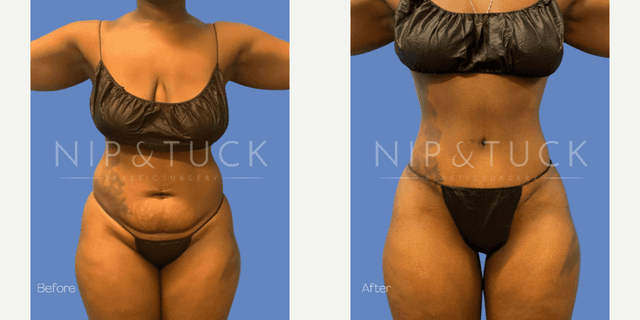 Skin Tightening procedure image